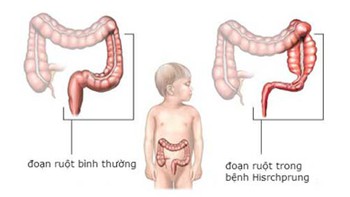 Trẻ sơ sinh bị táo bón có đáng lo?