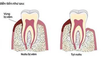 Tại sao cần phải cạo vôi răng?