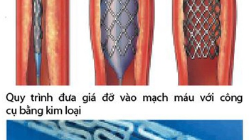 Nong động mạch vành bằng giá đỡ tự tiêu