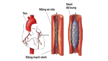 Dinh dưỡng và vận động sau đặt stent mạch vành