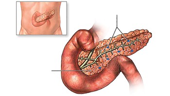 Ghép tụy và bệnh đái tháo đường