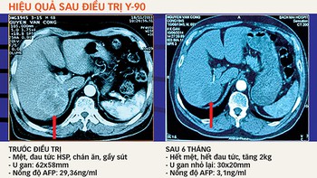 ​Cấy hạt vi cầu phóng xạ để điều trị ung thư gan