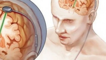 Kích thích não sâu để điều trị bệnh Parkinson