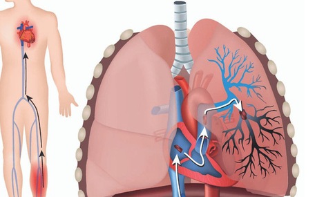 Cẩn thận bệnh 'sát thủ ẩn mình' thuyên tắc động mạch phổi gây tử vong nhanh trong 1-2 giờ