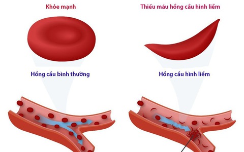 CÁC HÌNH THÁI BẤT THƯỜNG CỦA HỒNG CẦU Flashcards  Quizlet