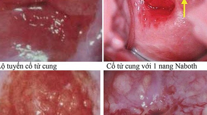 4. Chẩn đoán và điều trị viêm lộ tuyến nang naboth