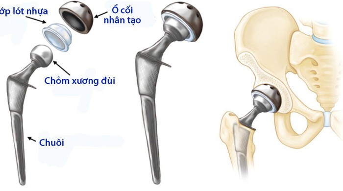 Thay khớp háng toàn phần - Tuổi Trẻ Online