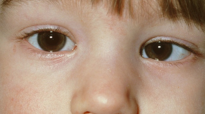 Lác mắt, nguyên nhân và cách điều trị - Tuổi Trẻ Online