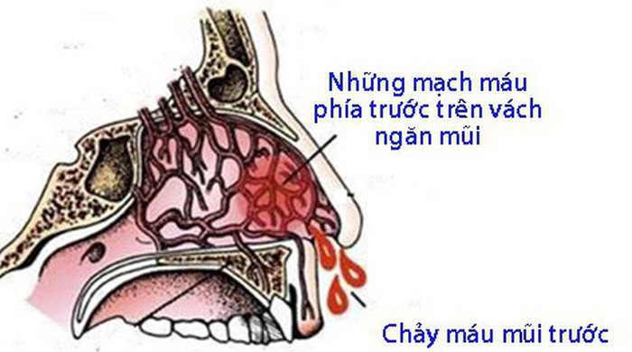 4. Chẩn đoán chảy máu điểm mạch mũi