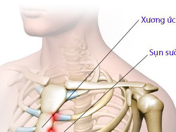 4. Các bệnh lý và tổn thương liên quan đến xương ức