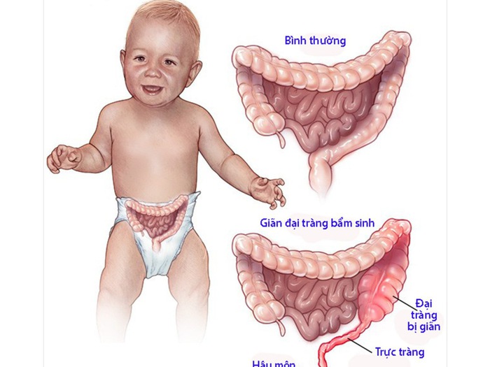 7. Câu Hỏi Thường Gặp Về Siêu Âm Và Giãn Đại Tràng