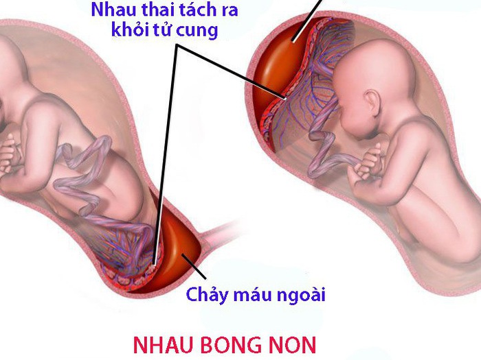 Ra Máu Khi Mang Thai Tháng Thứ 7: Nguyên Nhân, Triệu Chứng và Giải Pháp Hiệu Quả