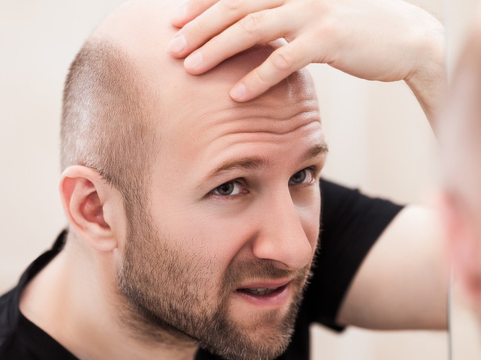 Rụng tóc khi gội đầu ở nam: Nguyên nhân và cách trị
