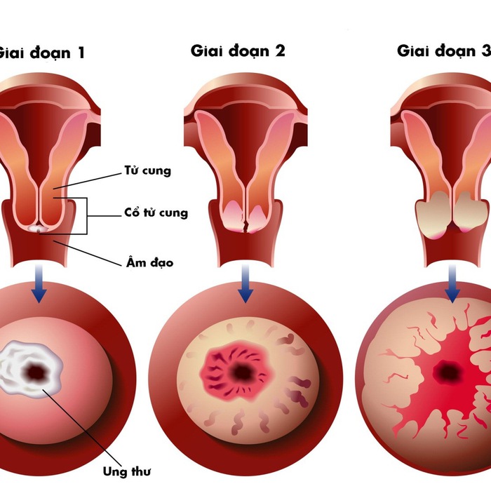 Kết luận về tầm quan trọng của Test Lugol