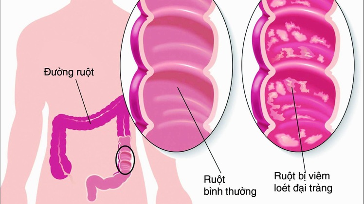 Phút cảnh báo: Cần hiểu hơn về viêm đại tràng mãn tính