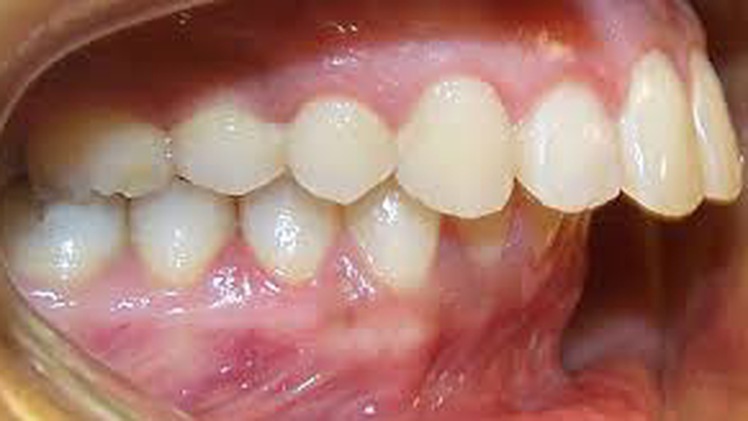 Khỏe đẹp cùng chuyên gia: Răng hô và hướng khắc phục - phần 3