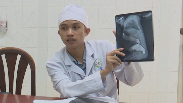 Nội soi cắt bỏ 20cm ruột cứu sống bé trai bị dị tật bẩm sinh