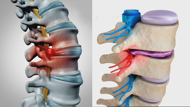 Tìm hiểu bệnh thoát vị đĩa đệm cột sống thắt lưng và cách điều trị