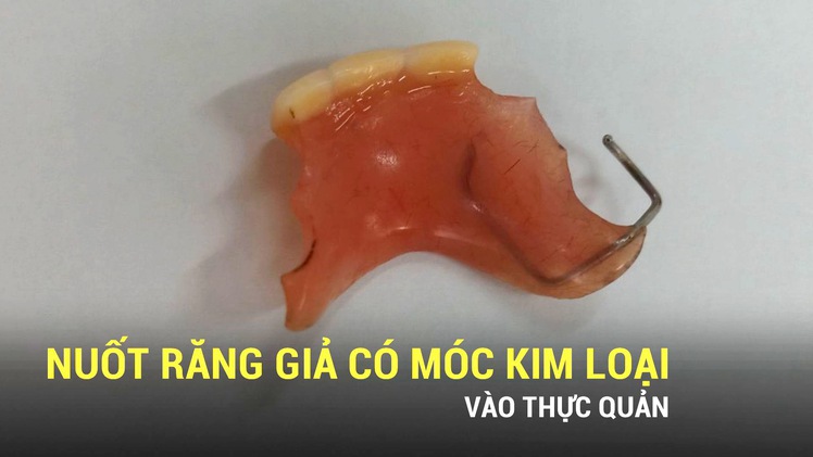 Vất vả xử lí cho bệnh nhân nuốt hàm răng giả có móc kim loại vào thực quản