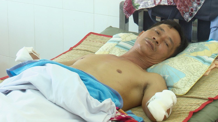 Tai nạn lao động khiến một người đàn ông mất cả 2 bàn tay