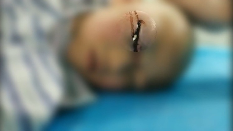 Video: Phẫu thuật lấy thanh thép dài 9 cm ra khỏi mắt cháu bé