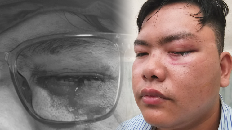 Công an nói gì về vụ thanh niên bị gậy CSGT ‘tác động’, mảnh vỡ mắt kính găm vào mắt?