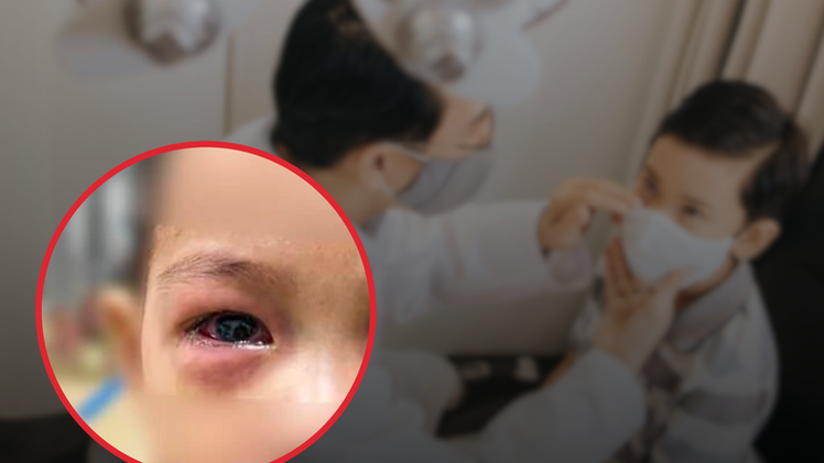 Cách phòng ngừa và điều trị bệnh đau mắt đỏ